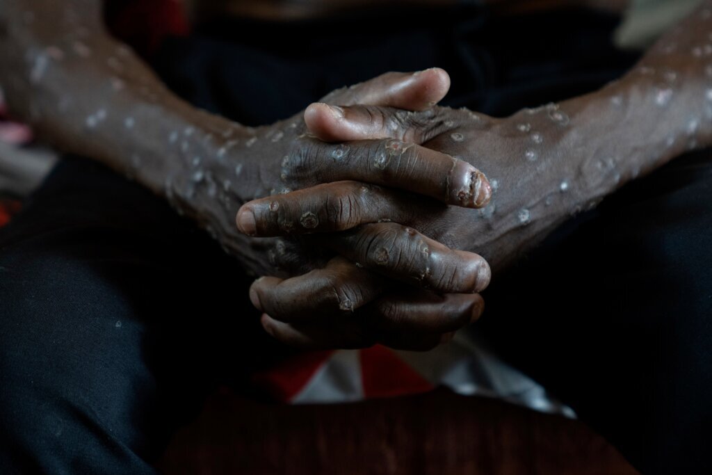 Congo Mpox Outbreak