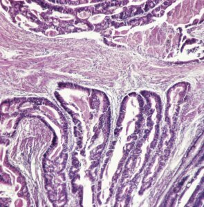 Section of rectal adenocarcinoma
